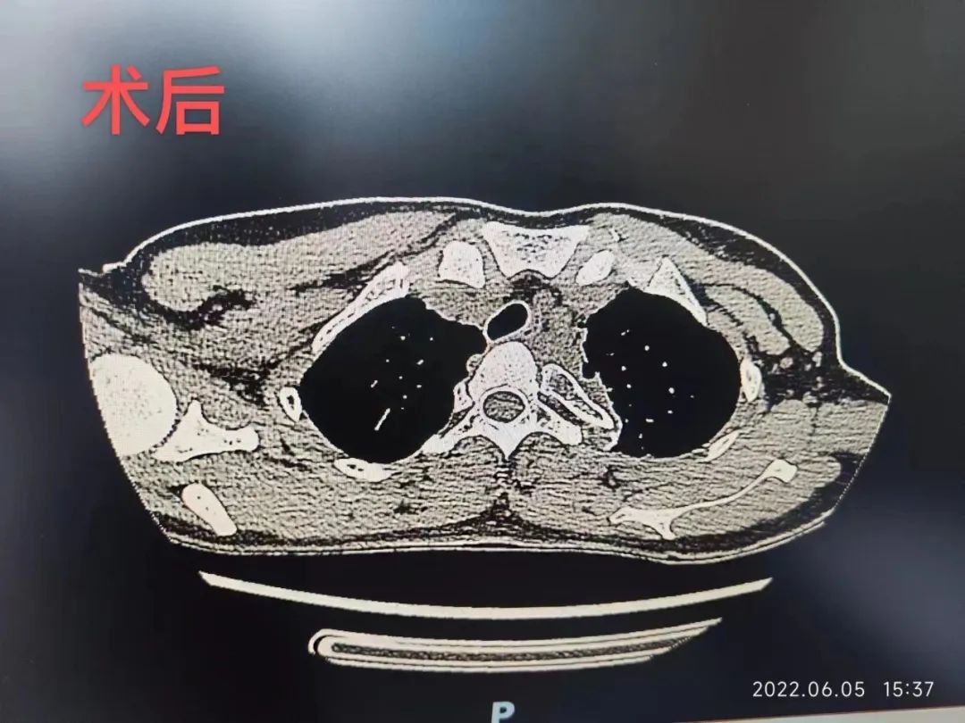 我院成功完成一例复杂纵膈肿瘤切除手术